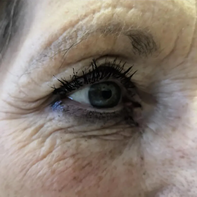 Facelifting obličeje
