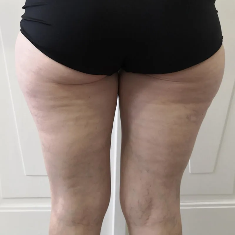 Liposukce vnějších stehen